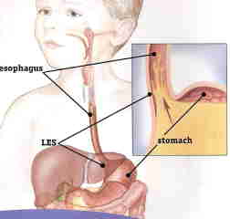 omeprazolo sciroppo per il reflusso gastroesofageo