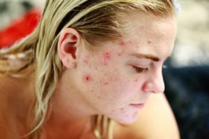 ittiolo unguento ictammolo per acne e brufoli