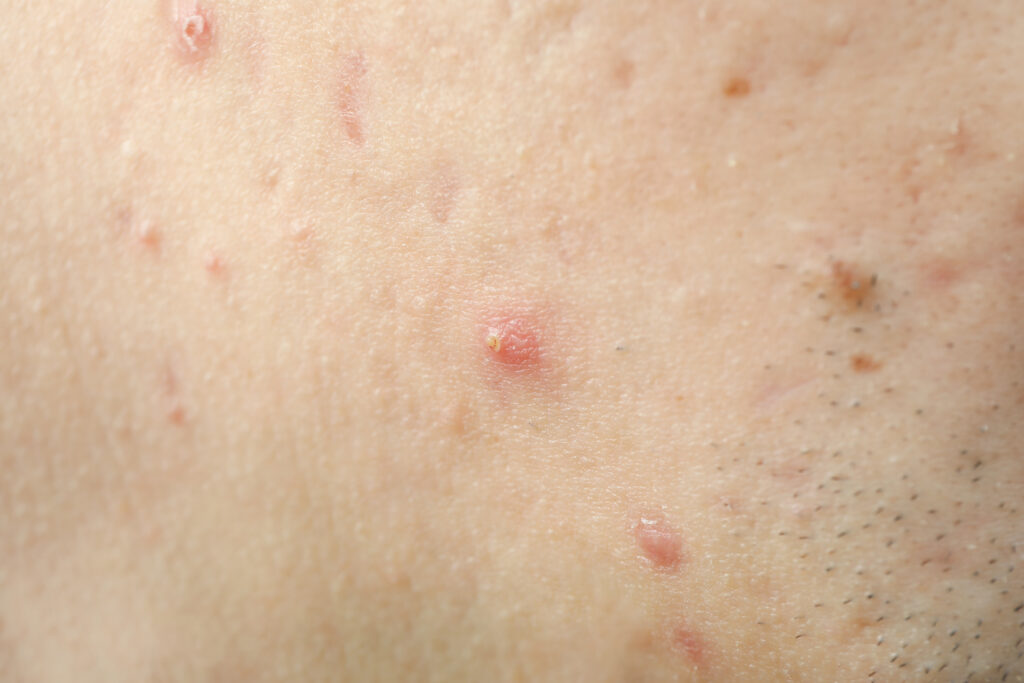 Dapsone capsule, farmaco galenico preparato in Farmacia per lebbra e malaria