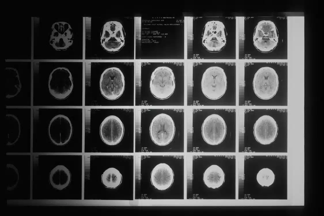 a black and white photo of brain with temozolamide